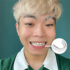 Invisalign clear braces