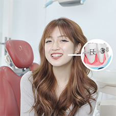 Economical braces